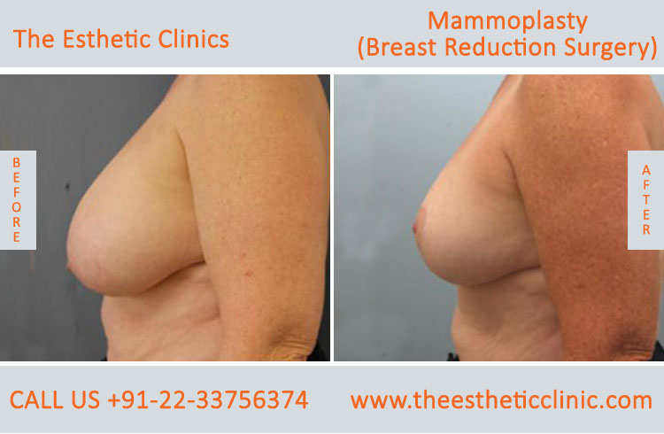 Mammoplasty, Breast Reduction Surgery before after photos in mumbai india (5)